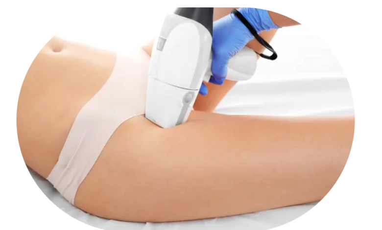 regl iken lazer yapılır mı